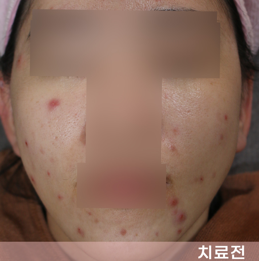 치료 전