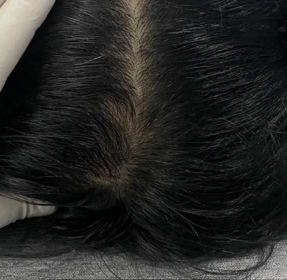 치료 후