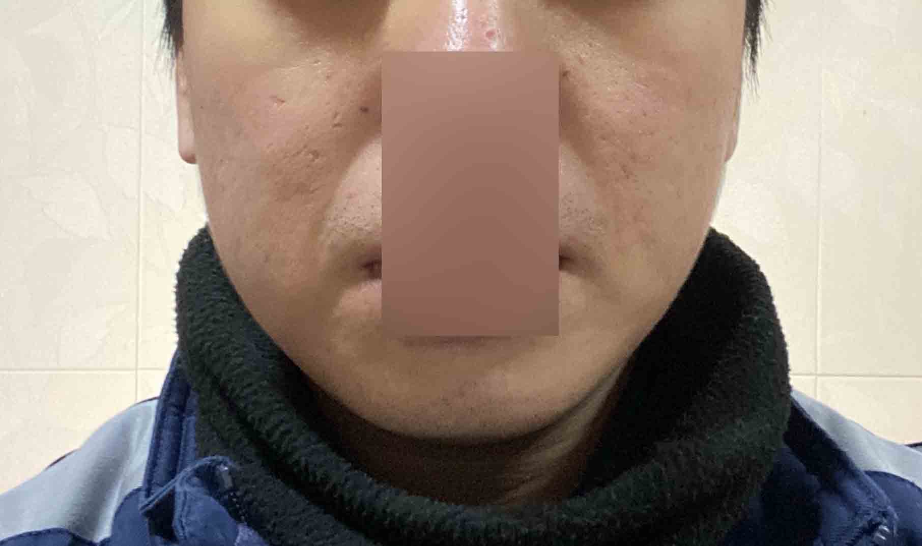 치료 후