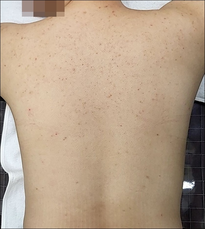 광주점 치료 전