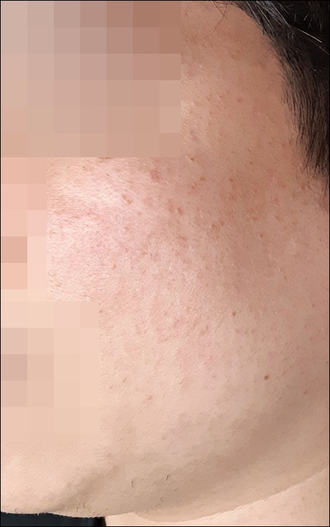 광주점 치료 전