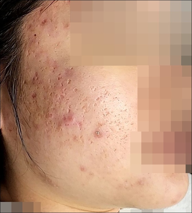 광주점 치료 전