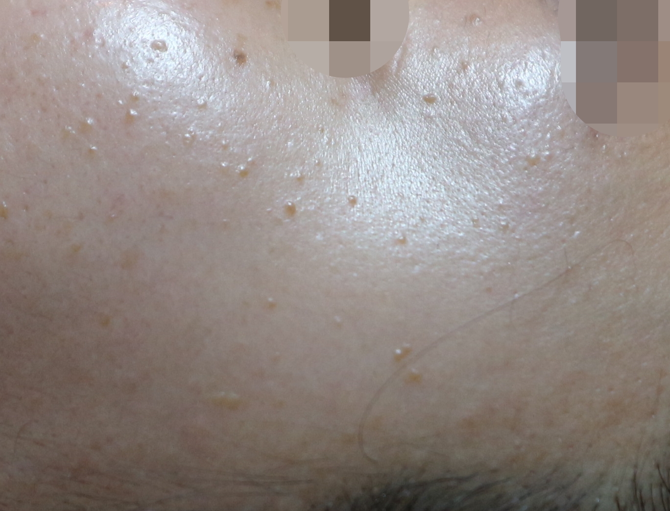 부천점 치료 전