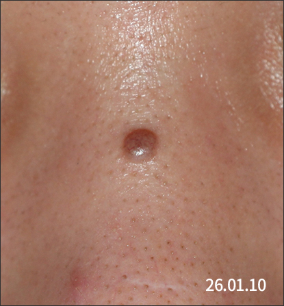 치료 전