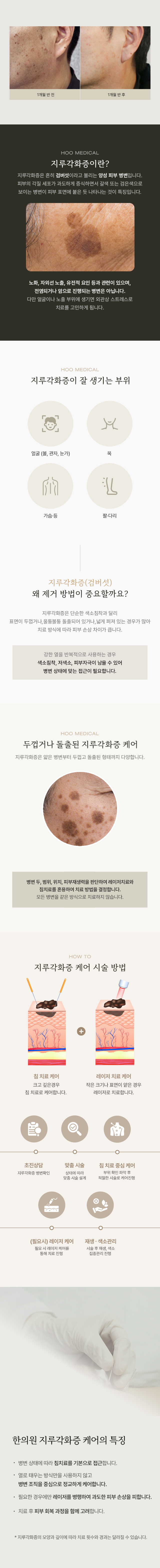 검버섯·지루각화증